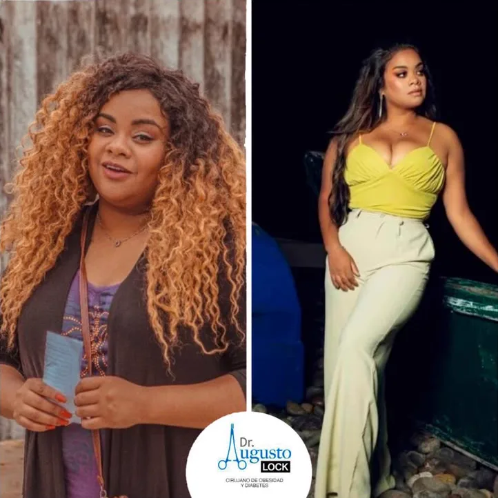 Miluska Eskenazi antes y después de su cirugía bariátrica