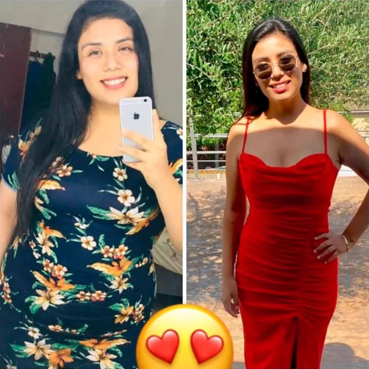 Paciente antes y después de su cirugía bariátrica