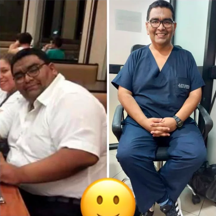 Paciente antes y después de su cirugía bariátrica