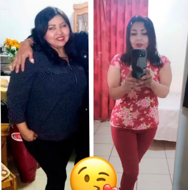 Paciente antes y después de su cirugía bariátrica