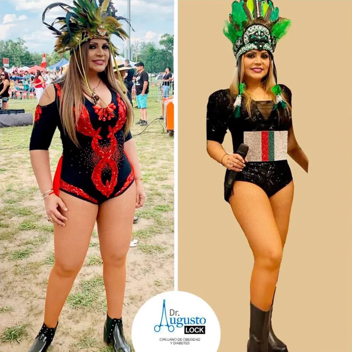 Ruth Karina antes y después de su cirugía bariátrica